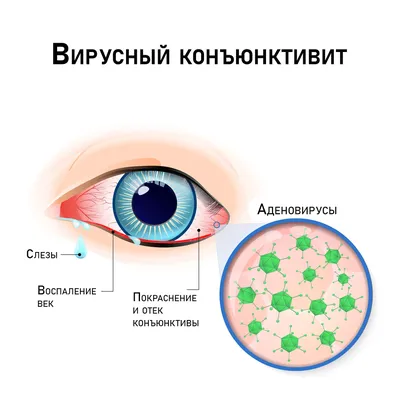 Вирусный конъюнктивит: причины, симптомы, признаки, виды, лечение