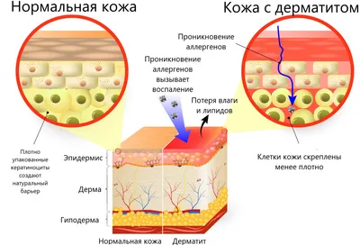 Контактный дерматит: что это, симптомы, лечение | РБК Стиль