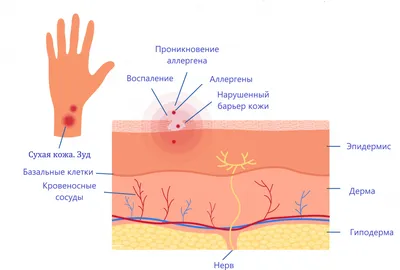 Простой контактный дерматит | Клиника «Александрия» в Нижнем Новгороде