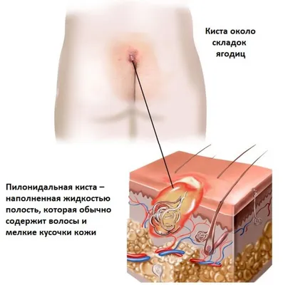 ИССЕЧЕНИЕ ЭПИТЕЛИАЛЬНО-КОПЧИКОВОГО ХОДА СОВМЕСТНО С ЭПИТЕЛИАЛЬНО-КОПЧИКОВОЙ  КИСТОЙ – СОВРЕМЕННЫЙ ПОДХОД К ЛЕЧЕНИЮ РАНЕВОГО ПРОЦЕССА – тема научной  статьи по клинической медицине читайте бесплатно текст  научно-исследовательской работы в электронной ...