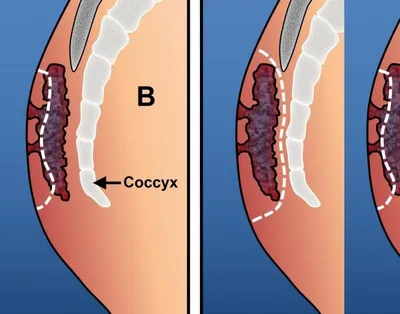 Вскрытие нагноившегося эпителиального копчикового хода в Хабаровске - Медикъ