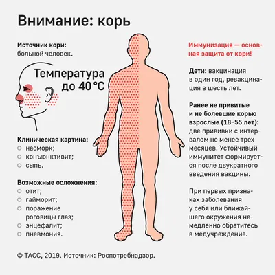 Внимание: корь - Инфографика ТАСС