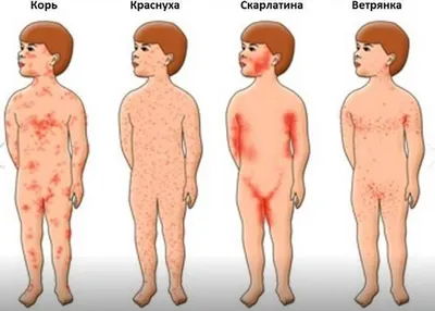 Корь у детей: Вспышка кори в России в 2023 году 🤒 - Евромед Кидс