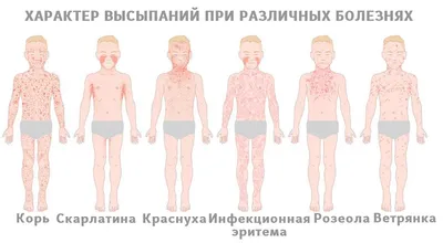 Корь, краснуха и паротит: что нужно знать об опасных болезнях | Дети в  городе Украина