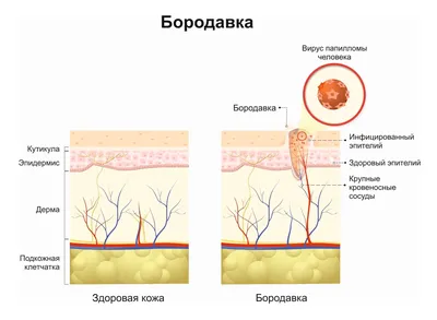 Избавляемся от бородавки | Центр подологии \"Щекотливая Тема\" | Дзен