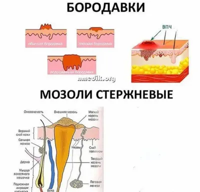 Лечение плоских бородавок на лице - Лазерсвiт