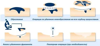 Корень бородавки - причины появления и варианты удаления. 85 фото корней  бородавок и строения образования