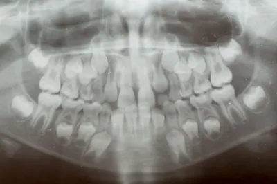Коренной зуб фото