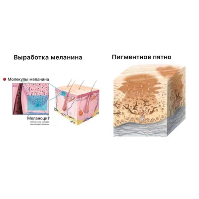 Как устранить пигментацию? | doc.ua