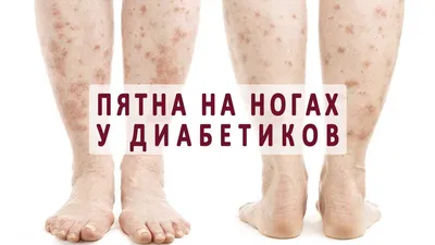 Пигментные коричневые пятна на ногах до колена с язвенными ямочками -  Вопрос дерматологу - 03 Онлайн