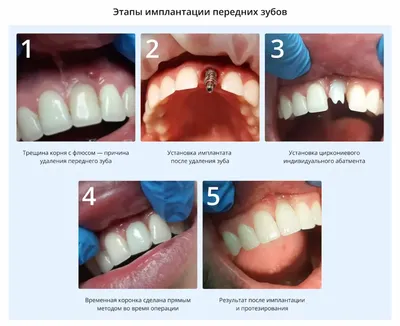 Безметалловые керамические коронки на основе циркония