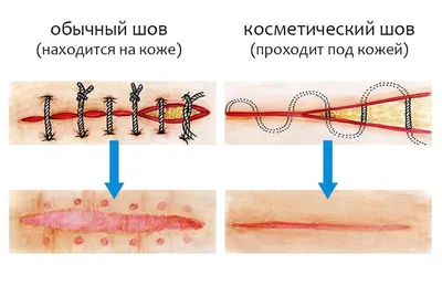 Каким будет рубец после пластической операции? | Заметки Пластического  Хирурга | Дзен