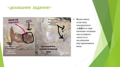 Косметические швы в хирургии. Виды и отличия от обычных кожных швов -  презентация онлайн