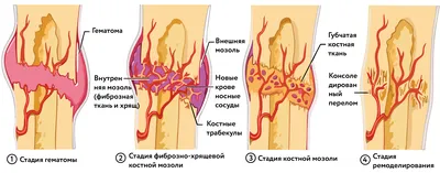 Что такое костная мозоль, как выявить и как лечить