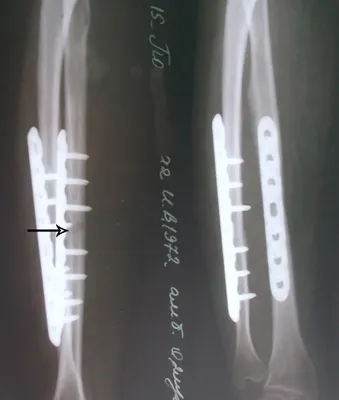 Здраствуйте,перелом,ставили спицы,прошло 3 недели.Идет ли процесс  заживления?и появилась ли костная мозоль? | ВКонтакте