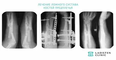 Костная мозоль после ринопластики - Что делать, чтобы избежать осложнений?