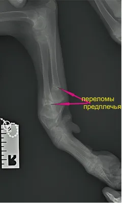 Уважаемые медики, прошу вашего мнения о переломе. | Пикабу