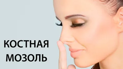 Да это уже не отек, а костная мозоль!\"-как я спустя 3,5 месяца после  ринопластики за 550 тыс узнала,что рискую снова попасть под нож хируга |  BEAUTIFORNIA | Дзен