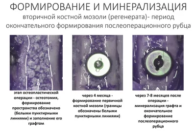 АНАЛИЗ РЕПАРАТИВНОГО ОСТЕОГЕНЕЗА ПРИ ДИАФИЗАРНЫХ ПЕРЕЛОМАХ КОСТЕЙ Г