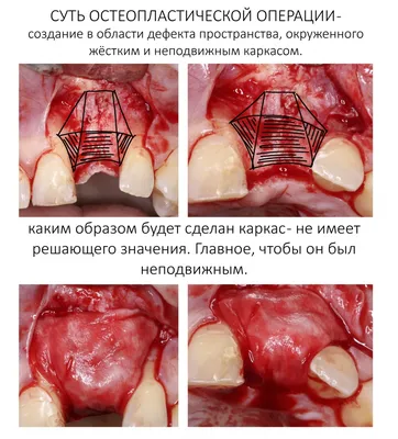 Презентация на тему: Костная мозоль