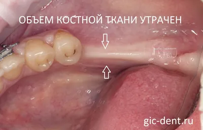Костная пластика и костная ткань зубов - Немецкий имплантологический центр