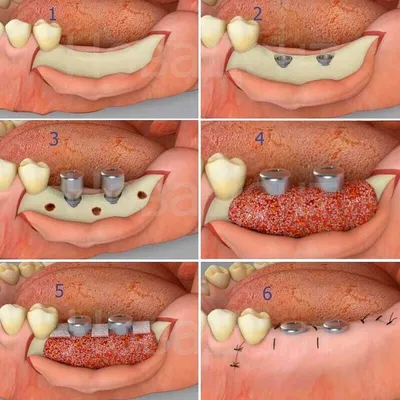 Костная пластика - Стоматология Оралпрофи - профессиональная помощь зубам