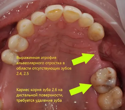 Исчезает костная ткань, оголяются зубы, наложена шина на передние зубы,  началось загноение - Пародонтология - Форум стоматологов (стомотологический  форум) - Профессиональный стоматологический портал (сайт) «Клуб  стоматологов»