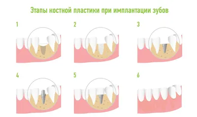 Костная пластика зубов Киев, Бровары - наращивание костной ткани