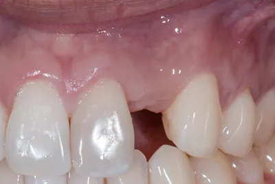 Костная пластика при имплантации зубов: виды, показания и осложнения