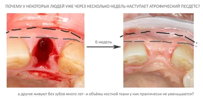 Заменители костной ткани для стоматологии: обзор материалов |  bioimplantat.ru
