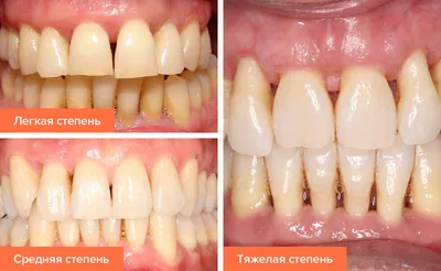 Костная пластика при имплантации зубов — отзывы, как делают, осложнения