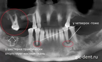 Атрофия костной ткани – главное осложнение после удаления зуба - YouTube