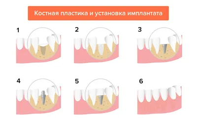 Аугментация костной ткани в стоматологической клинике Эстетика
