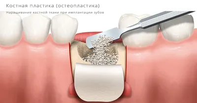 Костная пластика для имплантации зубов [цена в стоматологии Имплантмастер]