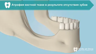 Костная пластика при имплантации зубов в Уфе | Стоматологическая клиника  «Маэстро»