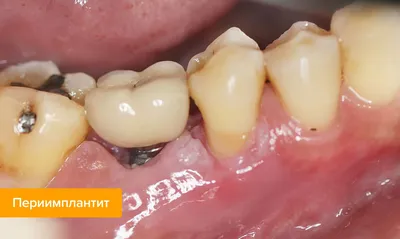 https://www.esteticadent.ru/stati/kak-i-dlya-chego-delayut-narashchivanie-kostnoy-tkani-pri-implantatsii-zubov/