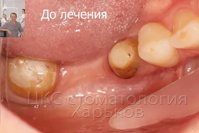 наращивание костной ткани для имплантации зубов