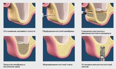 Пластика костной ткани - Доверие