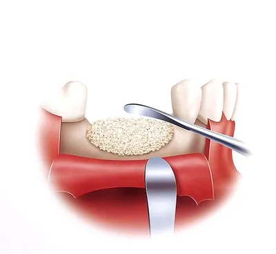 Имплантация костной ткани, костный имплант | ВАО ДЕНТ