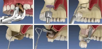 Костная пластика челюстей (зубов): цена при имплантации зубов в  стоматологии Твери