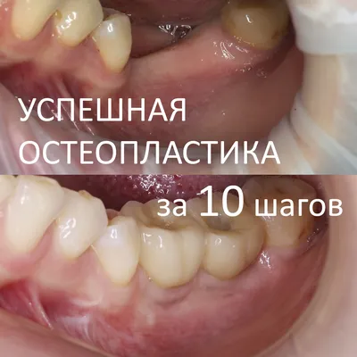 Успешное наращивание костной ткани за 10 шагов — CLINICIN.RU