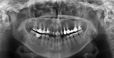 Деструкция костной ткани зуба, исследование очагов инфекции -  DENTALMAGAZINE.RU