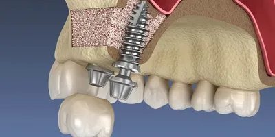 Костная пластика перед имплантацией зубов — когда и как делают