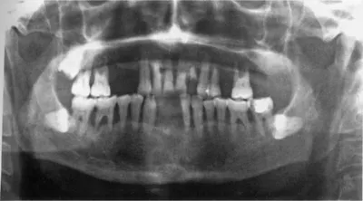 Деструкция костной ткани зуба, исследование очагов инфекции -  DENTALMAGAZINE.RU
