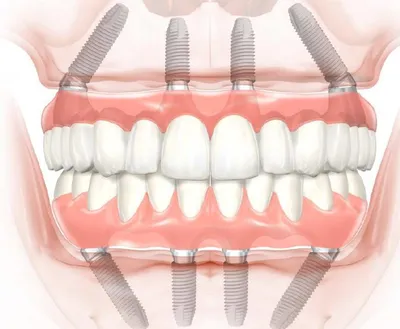 Костная пластика при имплантации зубов в СПб - Стоматологическая клиника  «Галерея Улыбок»