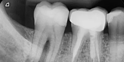 Остеопластика в стоматологии, наращивание костной структуры