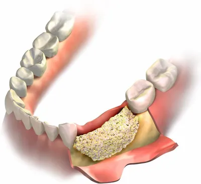 Атрофия костной ткани челюсти - стоимость услуги Имплантация в стоматологии  в Киеве, Атрофия костной ткани челюсти - цена в стоматологии  lipinskii.com.ua