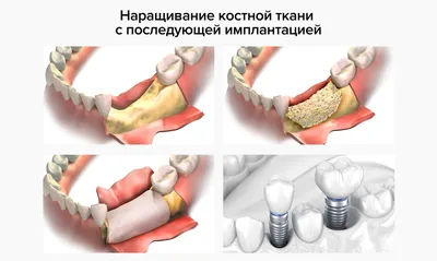 Воспаление в костной ткани, что делать | Консультация стоматолога на сайте  клиники Импладент