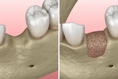 Наращивание костной ткани при имплантации в клинике «Альба-Дент»