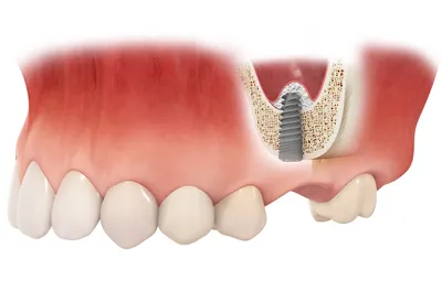 Костная пластика: Наращивание костной ткани при имплантации зубов цены в СПб